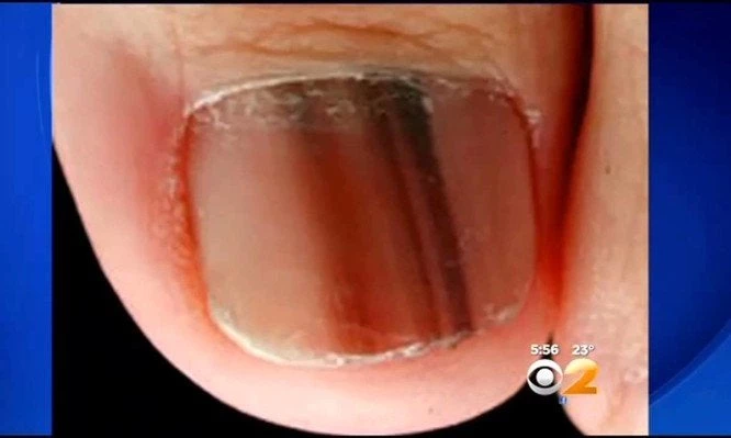 Προσοχή: Τι σημαίνει αν δείτε αυτό το σημάδι στο νύχι σας – Βίντεο